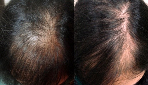 درمان ریزش مو در زنان و کاشت مو