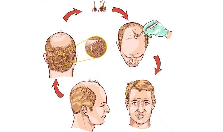 توضیح روند کاشت مو