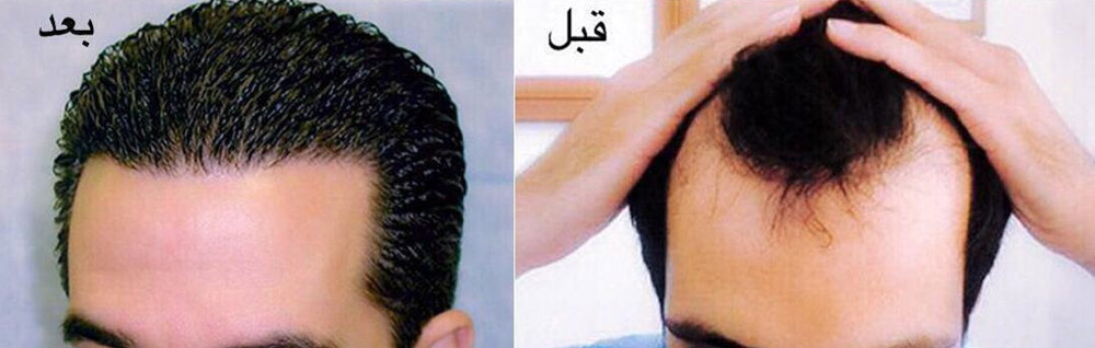 عکس قبل و بعد از کاشت مو
