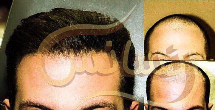 از صفر تا صد کاشت مو