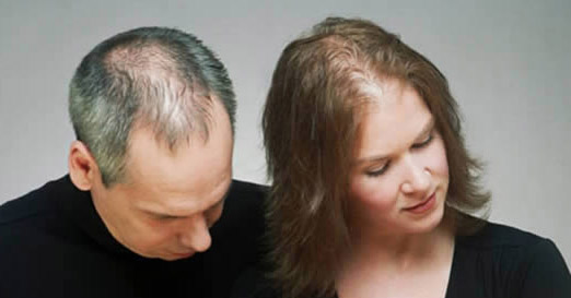 ریزش مو در مردان و زنان