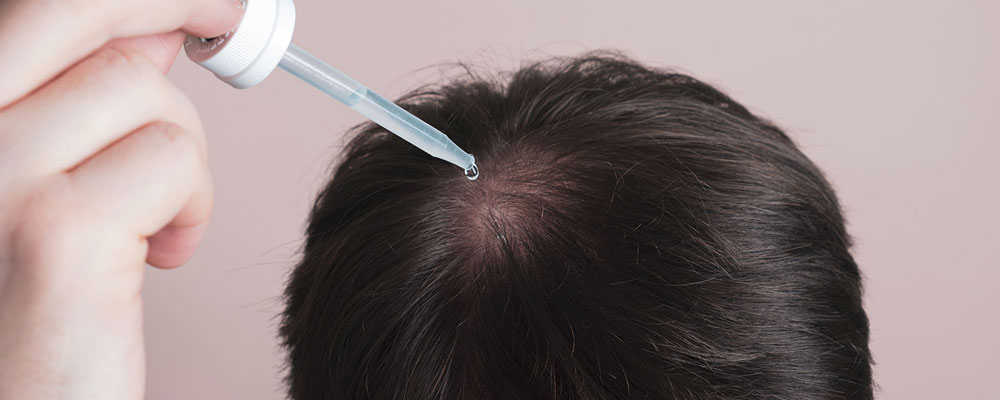 درمان ریزش مو با ماینوکسیدیل