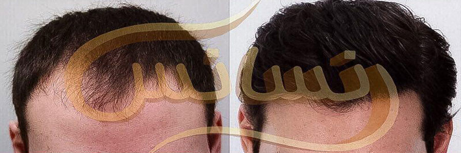 جدیدترین روش کاشت مو در ایران