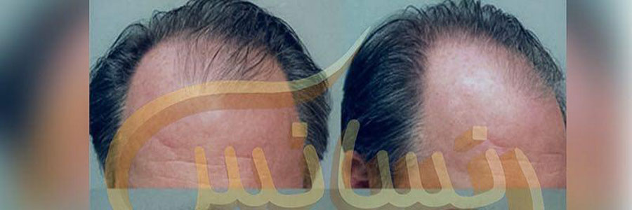 جدیدترین تکنیک کاشت مو در ایران