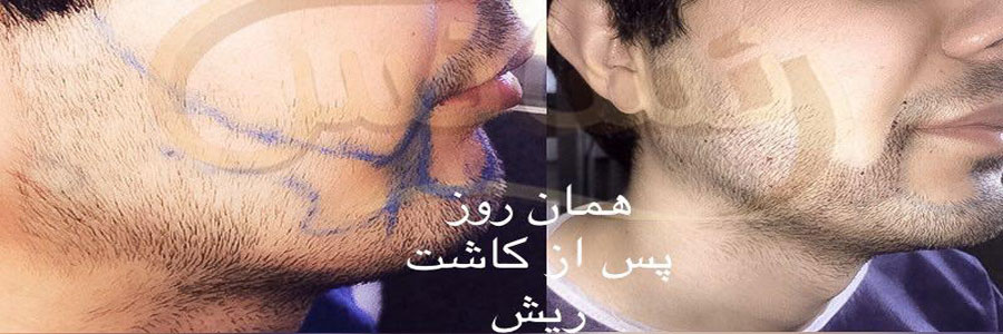 کاشت ریش عوارض و هزینه