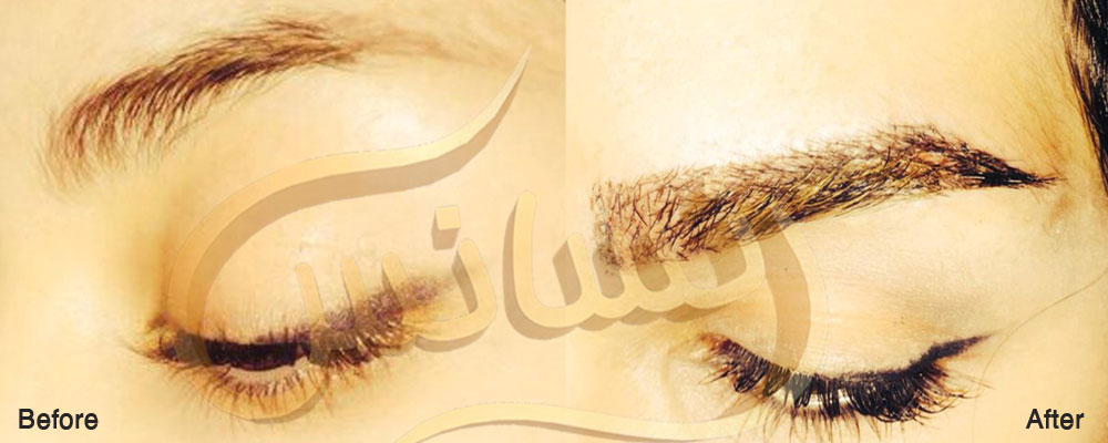 کاشت ابرو طبیعی
