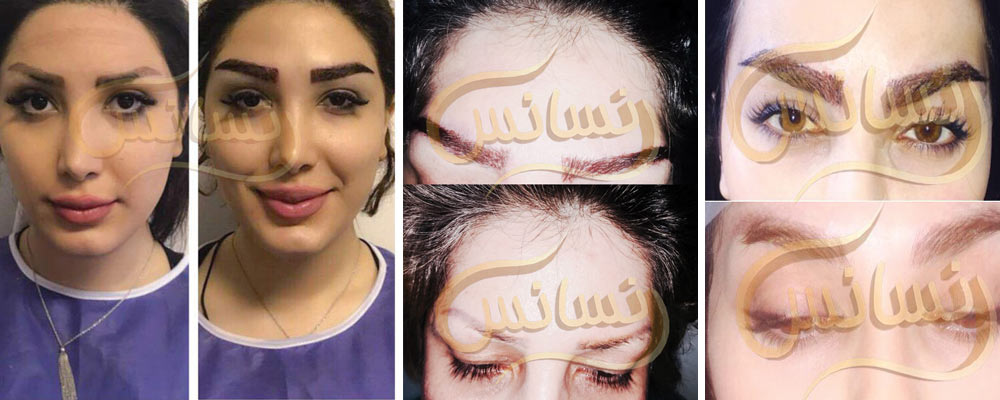 مراقبت های بعد از کاشت ابرو