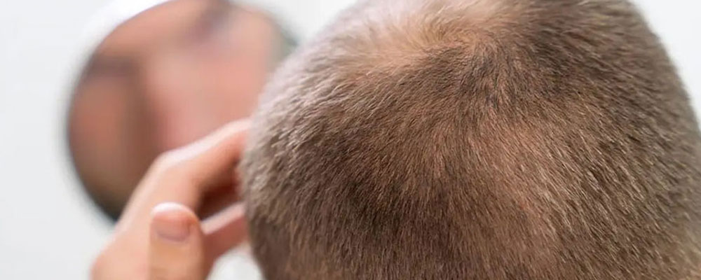 نقش بانک مو در بازسازی موهای از دست رفته