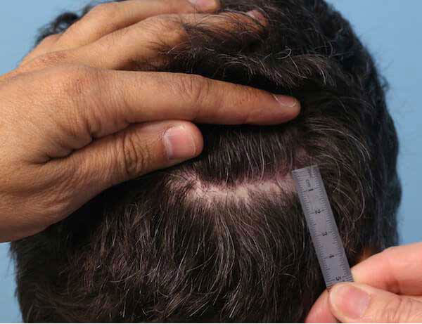 عوارض کاشت مو به روش sut