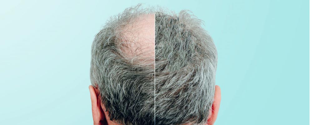 کاشت مو برای افراد بالای 50 سال