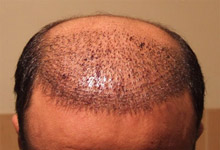 عوارض پس از کاشت مو