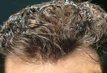درمان چربی موی سر