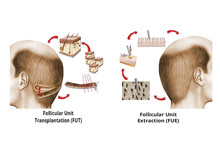 تفاوت کاشت مو به روش FUE با کاشت مو به روش FUT