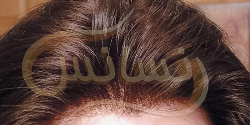ترمیم مو