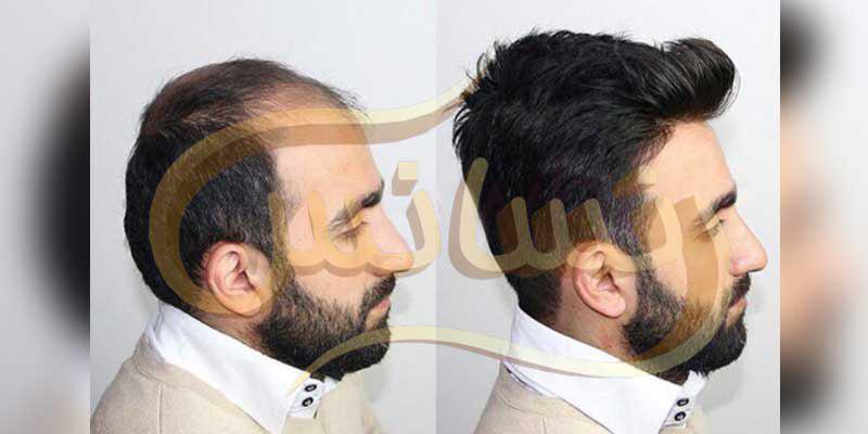 ترمیم مو