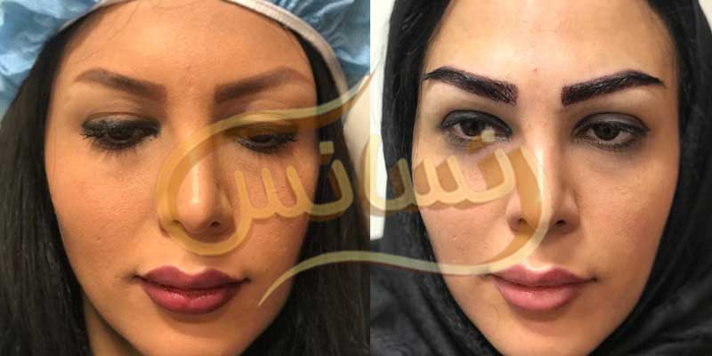 كاشت ابرو و مژه