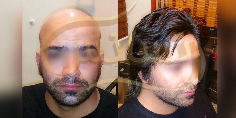 ترمیم مو
