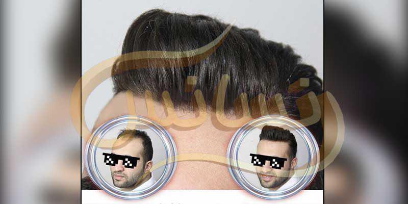 ترمیم مو