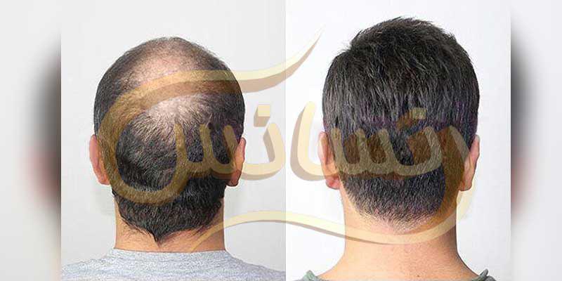 ترمیم مو