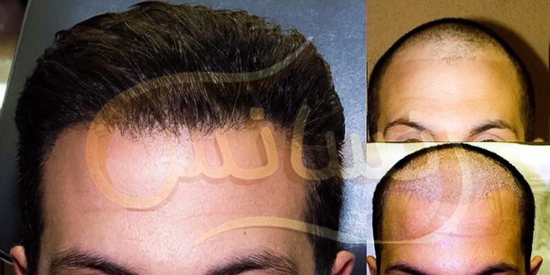 گالری تصاویر نمونه کارهای کاشت مو