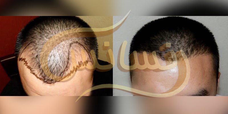 گالری تصاویر نمونه کارهای کاشت مو