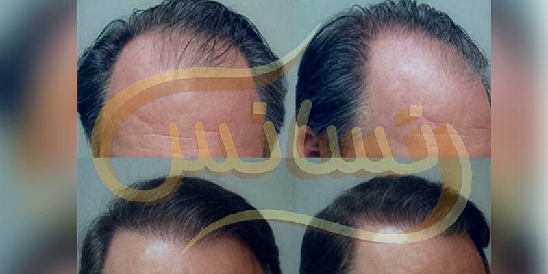 گالری تصاویر نمونه کارهای کاشت مو