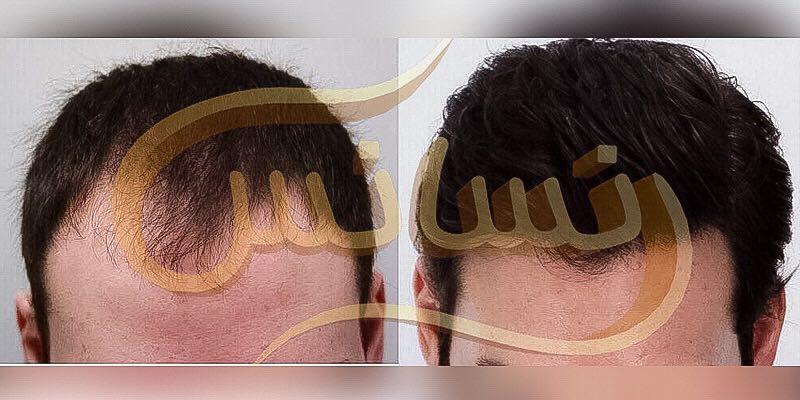 گالری تصاویر نمونه کارهای کاشت مو