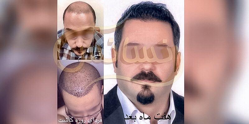 گالری تصاویر نمونه کارهای کاشت مو