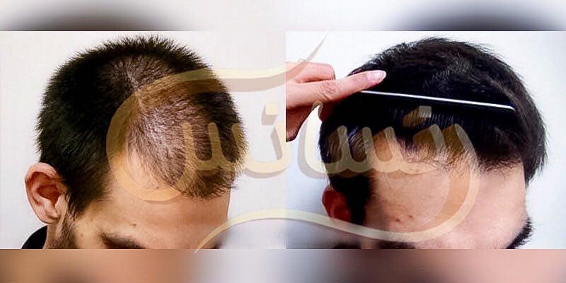 گالری تصاویر نمونه کارهای کاشت مو