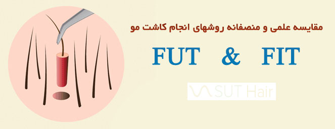 مقایسه روش های کاشت مو FIT و FUE