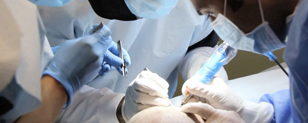 کاشت مو در دوران کرونا