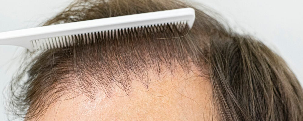 آیا ریزش مو یک بیماری است؟