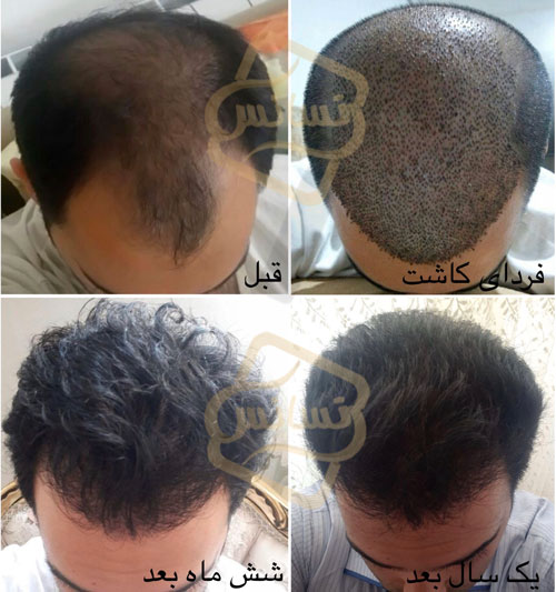 نکات قبل از کاشت مو