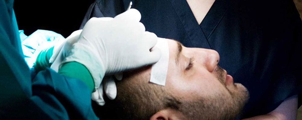 جایگزین های کاشت مو