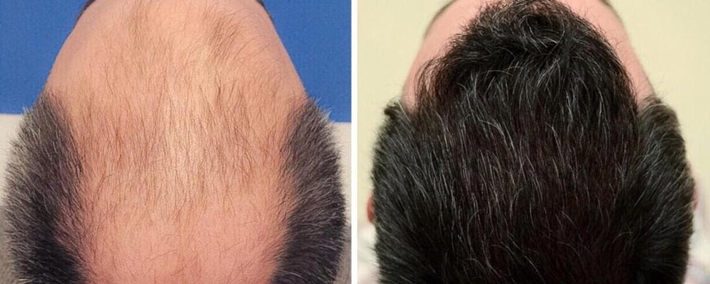 آگاهی از عوارض بعد از عمل و ریسک کاشت مو