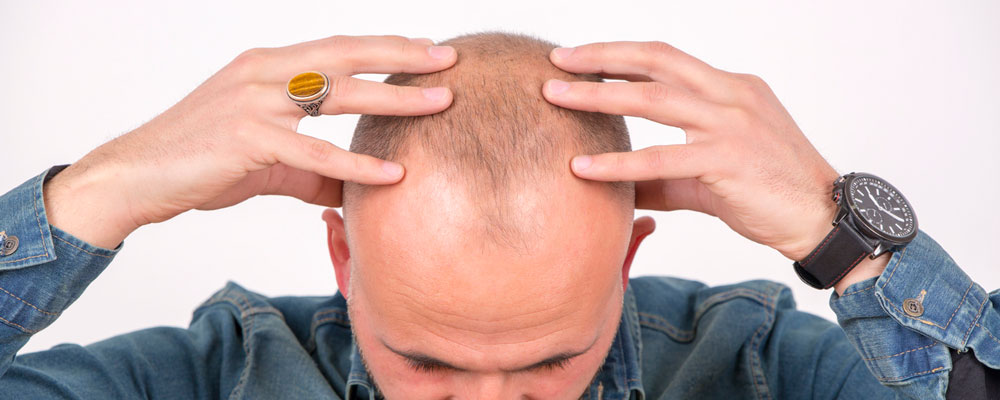 مراقبت های قبل از کاشت مو