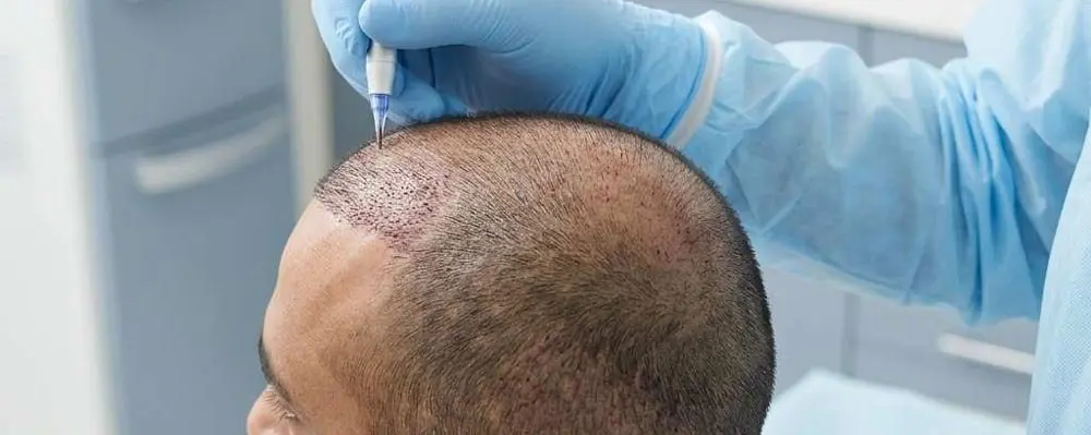 مزایای کاشت مو به روش FUE