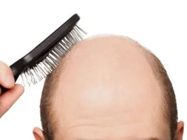 کاشت مو به روش BHT